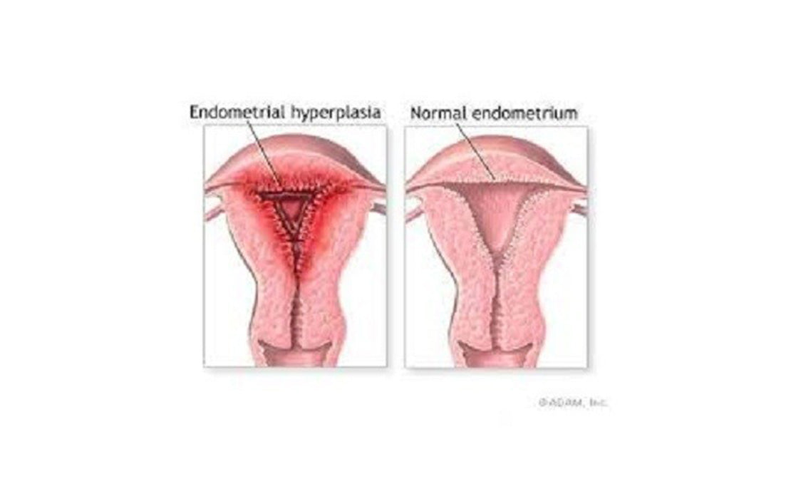 Endometrial Hyperplasia