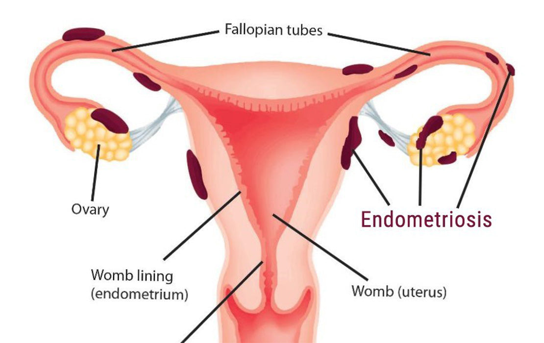 Endometriosis