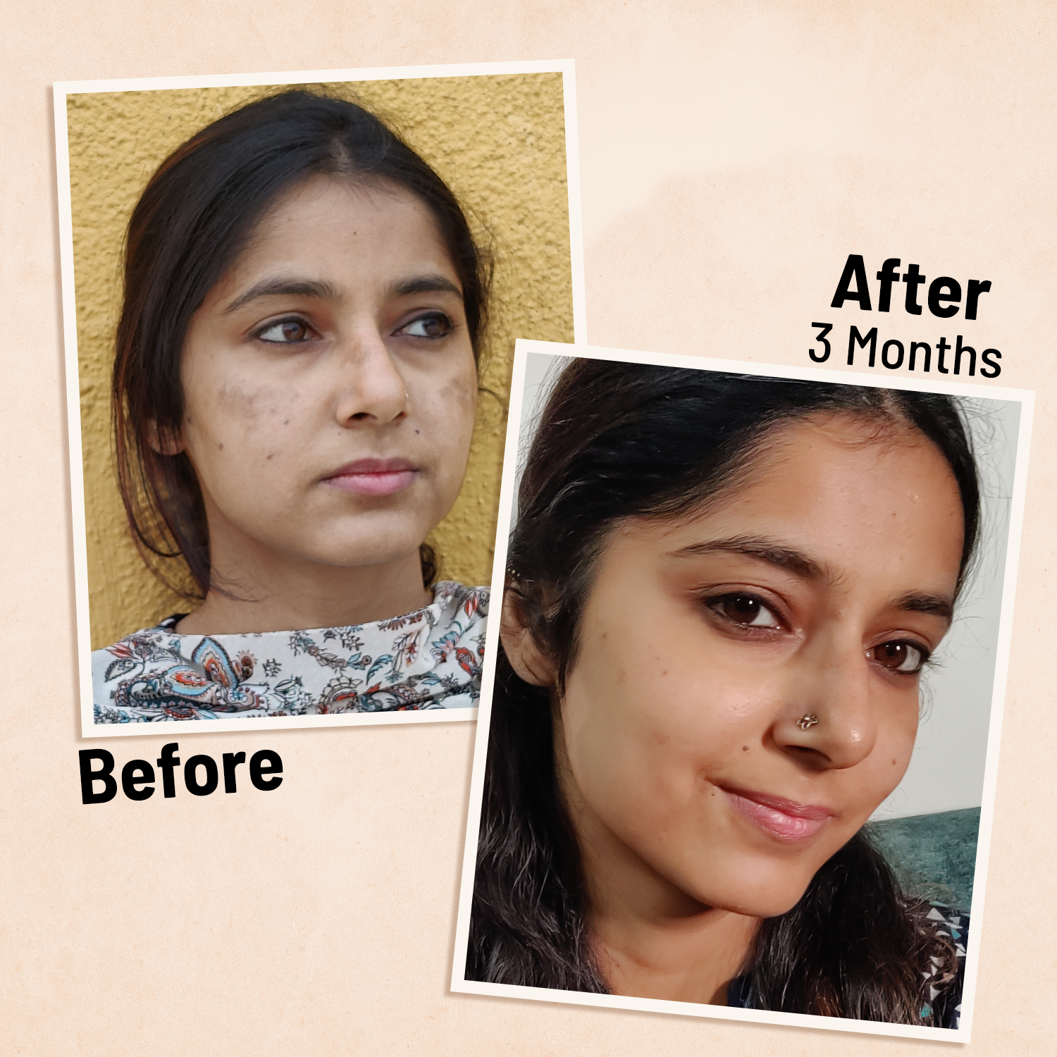 Anti Pigmentation Solution