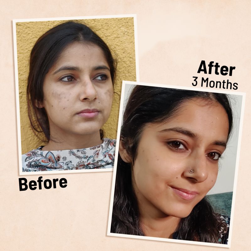 Anti Pigmentation Solution